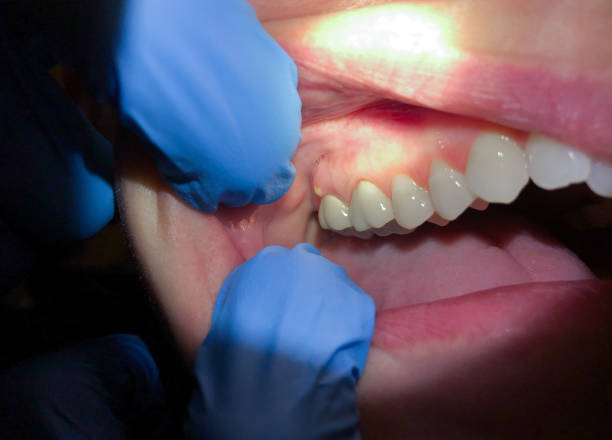 Best Tooth Infection Emergency Dentist  in Ball Ground, GA